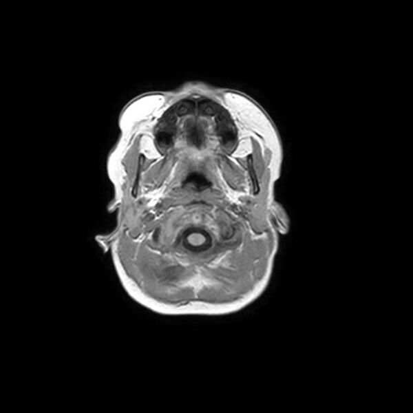 File:Cochlear nerve aplasia - unilateral (Radiopaedia 87910-104413 Axial T1 2).jpg