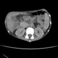 Colocolic fistula - Crohn disease (Radiopaedia 57063-63955 A 29).jpg