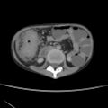 Colocolic fistula - Crohn disease (Radiopaedia 57063-63955 A 36).jpg