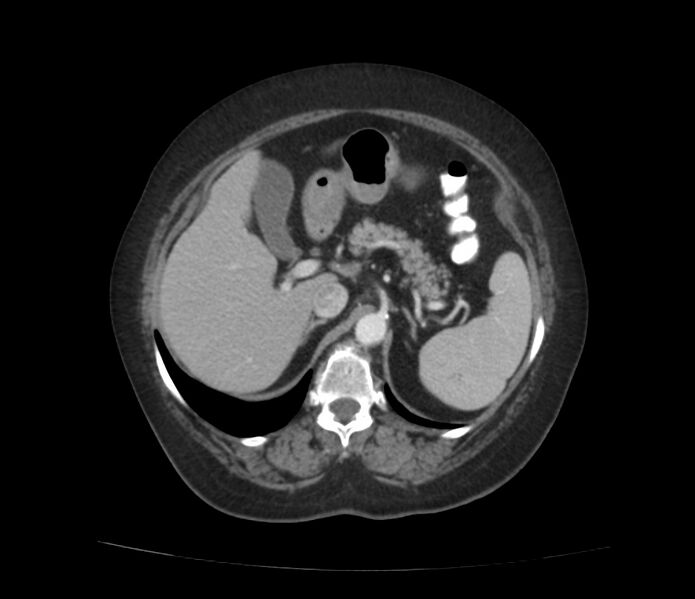File:Colonic diverticulosis (Radiopaedia 22934-22957 A 19).jpg