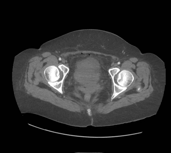 File:Colonic pseudo-obstruction (Radiopaedia 79752-92980 A 179).png