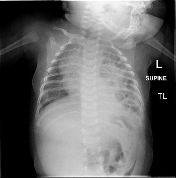 File:Congenital diaphragmatic hernia (Radiopaedia 50971).jpg