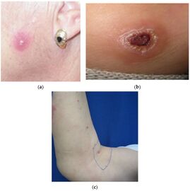 a-c)Types of Cutaneous leishmaniasis
