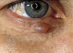 More images of hidrocystoma of the eyelid. (DermNet NZ hidrocystoma-01).jpg