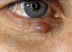 Hidrocystoma of the eyelid