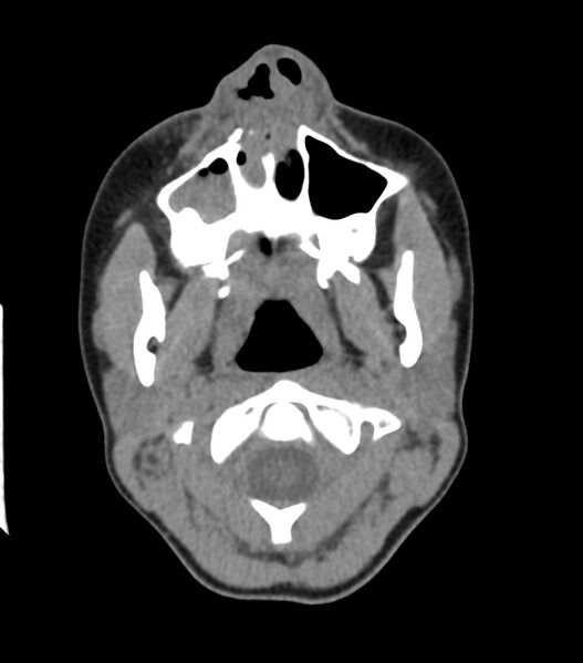 File:Nasoorbitoethmoid fracture (Radiopaedia 90044-107205 Axial non-contrast 105).jpg