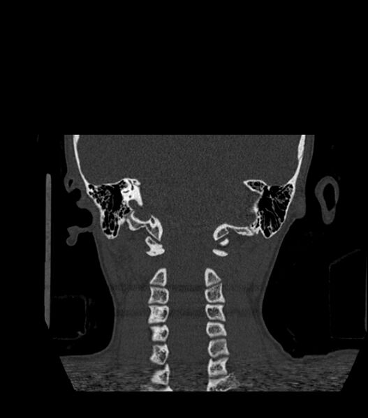 File:Nasoorbitoethmoid fracture (Radiopaedia 90044-107205 Coronal bone window 114).jpg