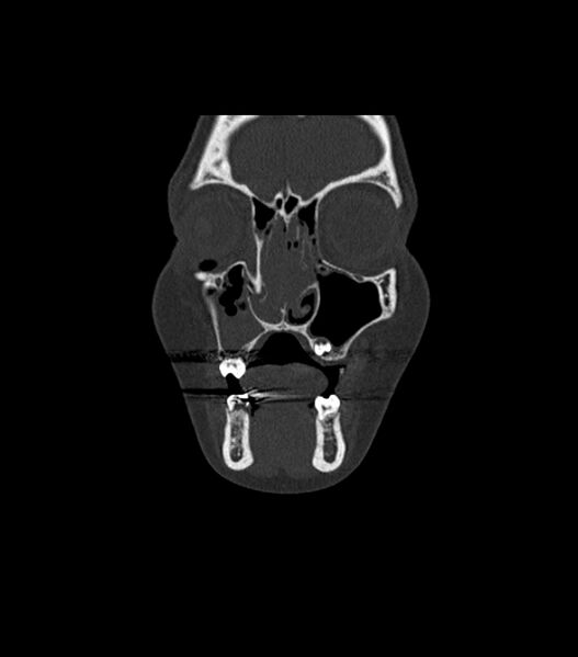 File:Nasoorbitoethmoid fracture (Radiopaedia 90044-107205 Coronal bone window 37).jpg