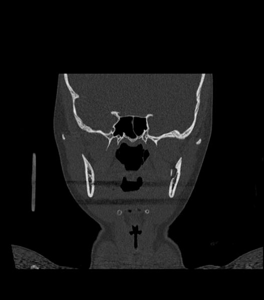 File:Nasoorbitoethmoid fracture (Radiopaedia 90044-107205 Coronal bone window 74).jpg