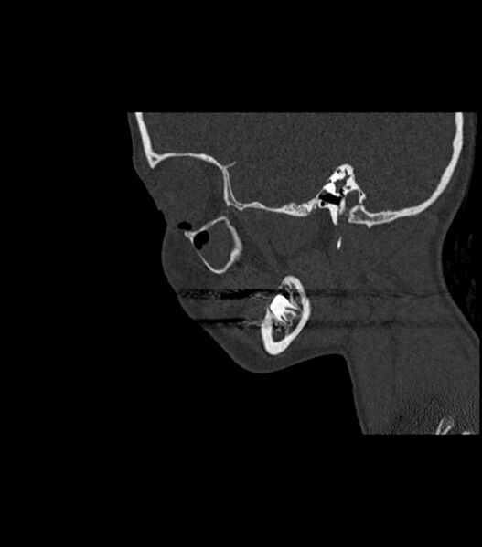 File:Nasoorbitoethmoid fracture (Radiopaedia 90044-107205 Sagittal bone window 105).jpg
