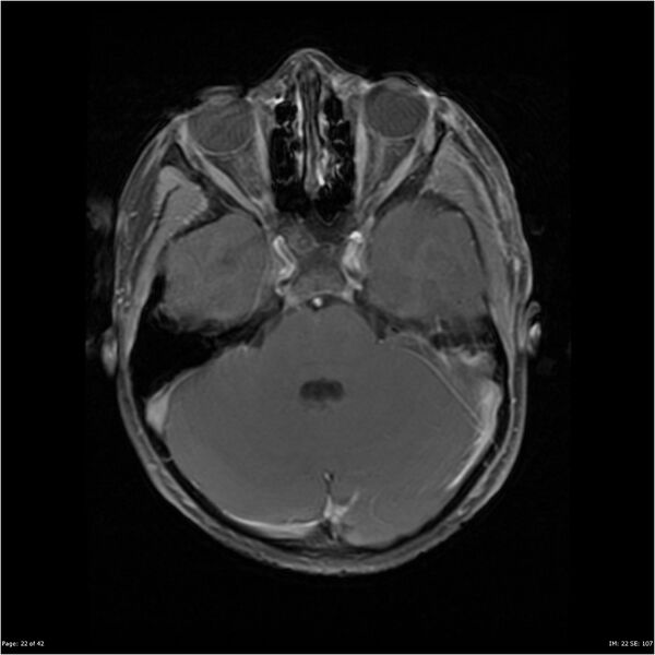 File:Neurofibromatosis type 1 (Radiopaedia 22541-22564 Axial T1 C+ fat sat 22).jpg