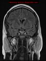 Neuroglial cyst (Radiopaedia 10713-11184 Coronal FLAIR 16).jpg