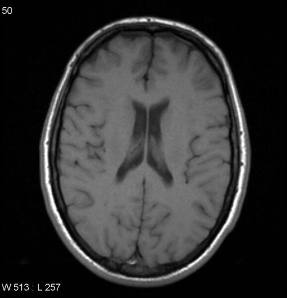 File:Neurosarcoidosis (Radiopaedia 10930-17204 Axial T1 12).jpg