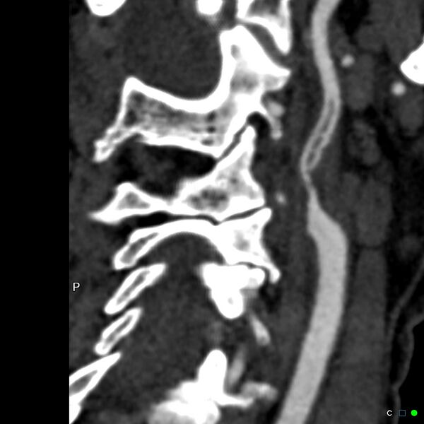 File:Non-occlusive intraluminal internal carotid artery thrombus (Radiopaedia 37751-39658 A 28).jpg