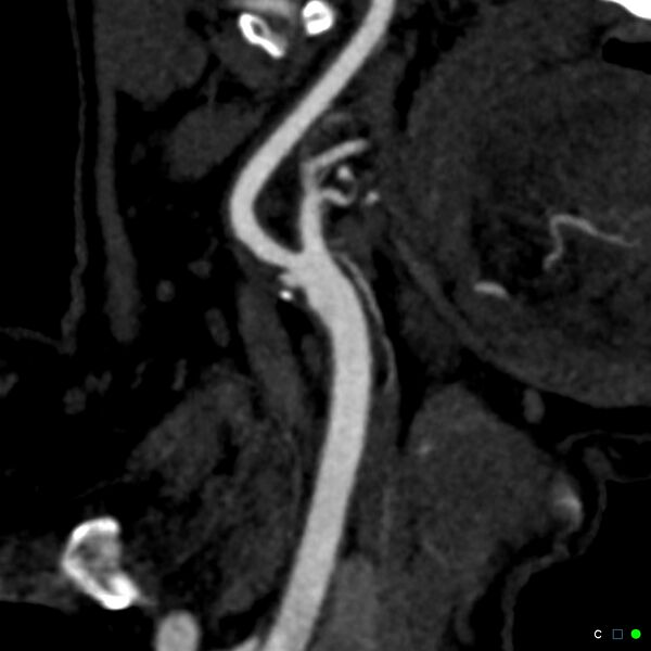 File:Non-occlusive intraluminal internal carotid artery thrombus (Radiopaedia 37751-39658 C 24).jpg