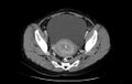 Non-puerperal uterine inversion (Radiopaedia 78343-91094 A 21).jpg