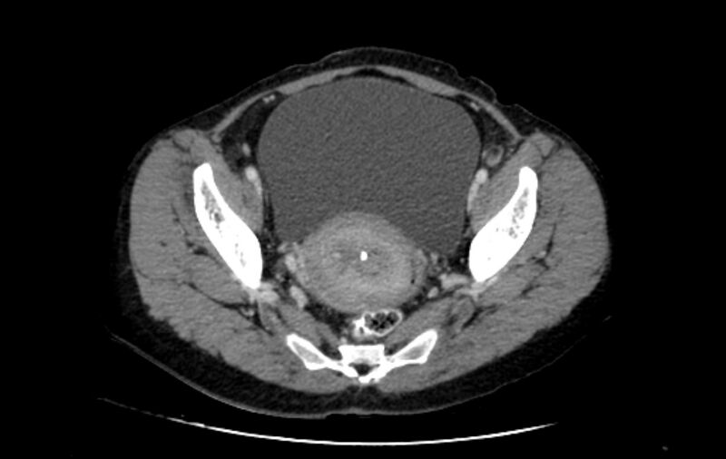 File:Non-puerperal uterine inversion (Radiopaedia 78343-91094 A 21).jpg