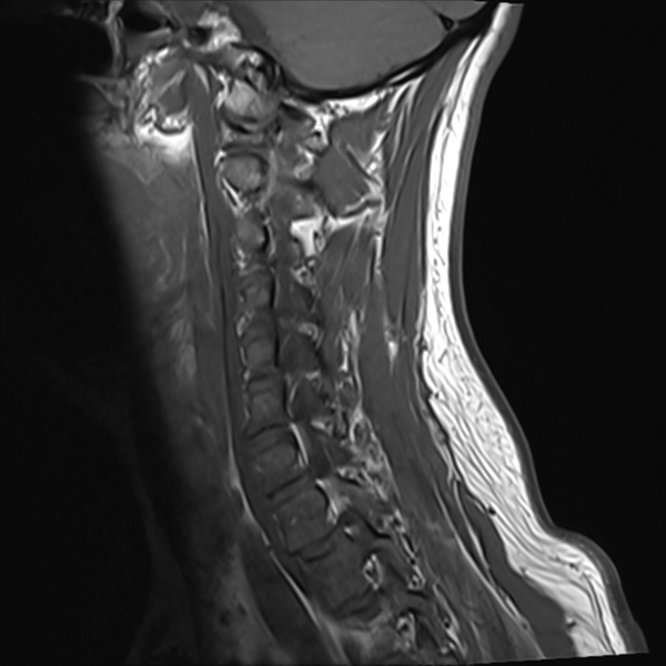 File:Normal MRI cervical spine (infection protocol) (Radiopaedia 53916-60039 Sagittal T1 4).png