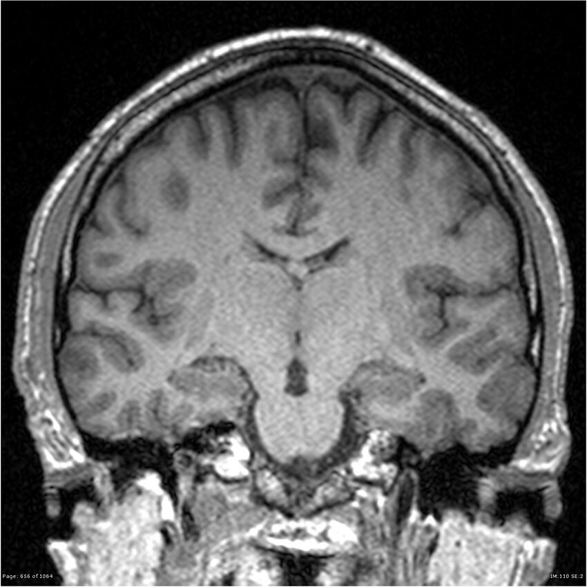 Normal brain MRI (non-focal epilepsy protocol) (Radiopaedia 38571-40700 Coronal T1 54).jpg