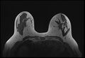 Normal breast MRI - dense breasts (Radiopaedia 80454-93850 Axial T1 107).jpg