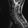 Normal cervical spine MRI (Radiopaedia 38418-40496 Sagittal T2 8).jpg