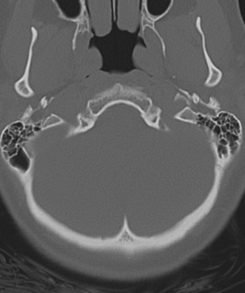 File:Normal cervical spine MRI (including Dixon) (Radiopaedia 42762-45926 Axial bone window 5).png