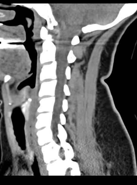 File:Normal cervical spine MRI (including Dixon) (Radiopaedia 42762-45926 C 26).png