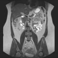 Normal liver MRI with Gadolinium (Radiopaedia 58913-66163 Coronal T2 21).jpg