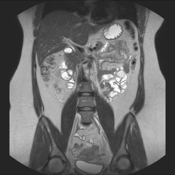 File:Normal liver MRI with Gadolinium (Radiopaedia 58913-66163 Coronal T2 21).jpg