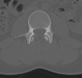 Normal lumbar spine CT (Radiopaedia 46533-50986 Axial bone window 33).png