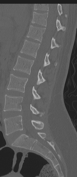 File:Normal lumbosacral CT (Radiopaedia 37923-39867 Sagittal bone window 51).png