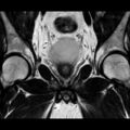 Normal prostate (MRI) (Radiopaedia 29986-30535 Coronal T2 8).jpg