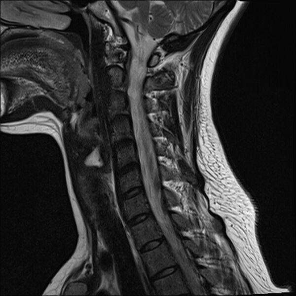 File:Normal trauma cervical spine MRI (Radiopaedia 32130-33071 Sagittal T2 10).jpg