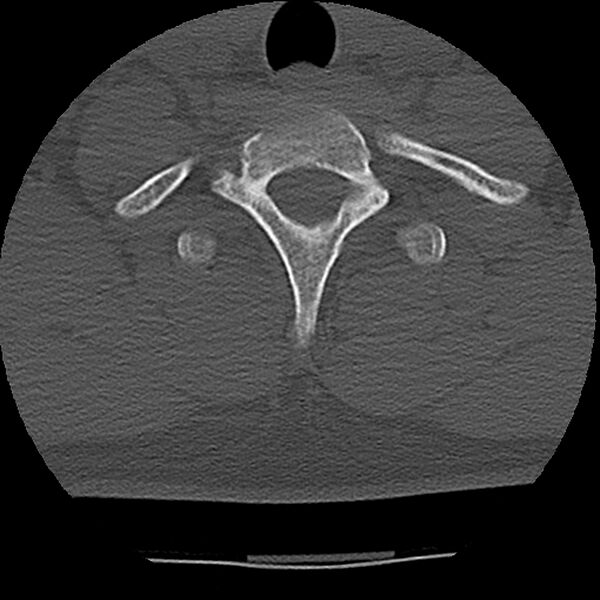 File:Normal trauma spine imaging (Radiopaedia 31753-32686 Axial bone window 74).jpg
