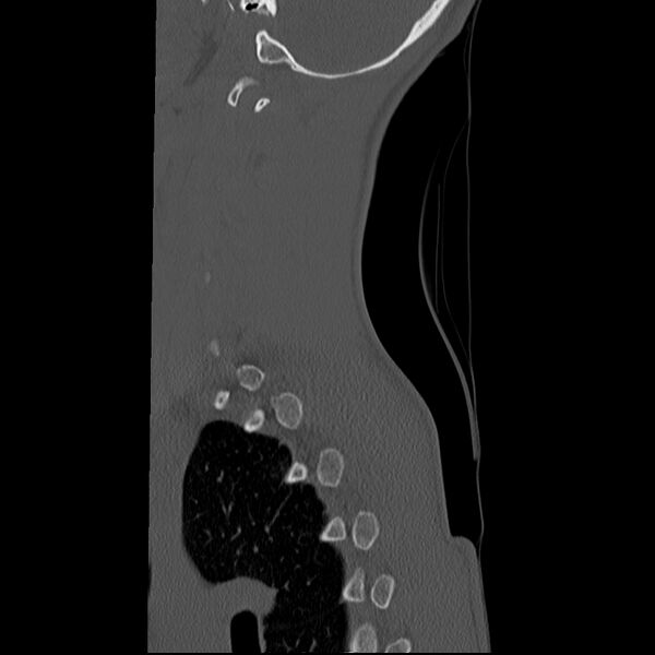 File:Normal trauma spine imaging (age 16) (Radiopaedia 45335-49358 Sagittal bone window 5).jpg