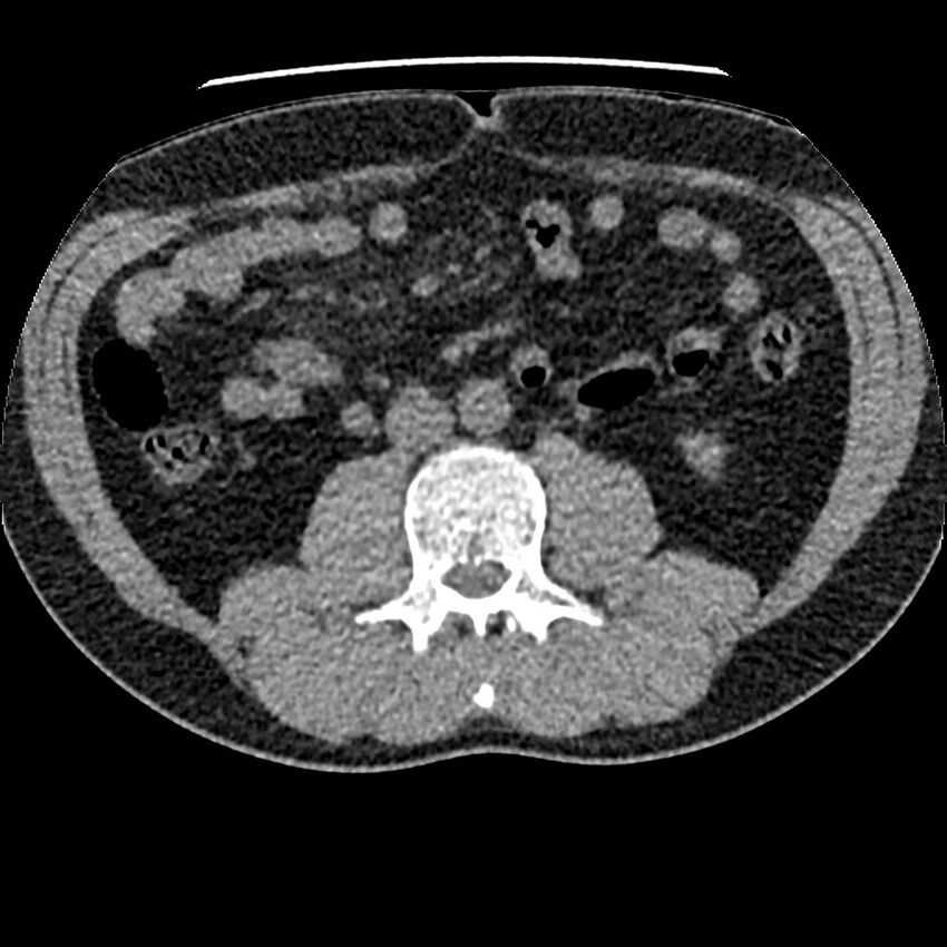 Obstructing ureteric calculus and ureteric anatomy (Radiopaedia 62730-71042 Axial non-contrast 66).jpg