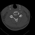 Occipital condyle fracture (Radiopaedia 31755-32691 Axial bone window 44).jpg