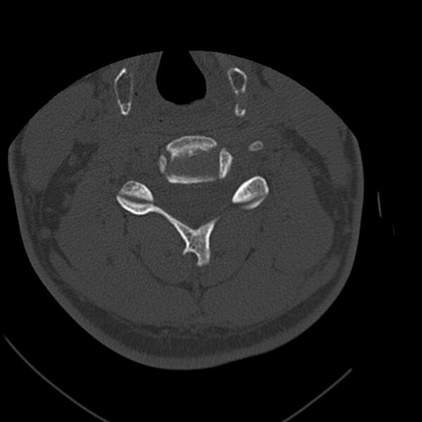 File:Occipital condyle fracture (Radiopaedia 31755-32691 Axial bone window 44).jpg
