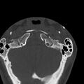 Occipital condyle fracture (Radiopaedia 31755-32691 Axial bone window 7).jpg