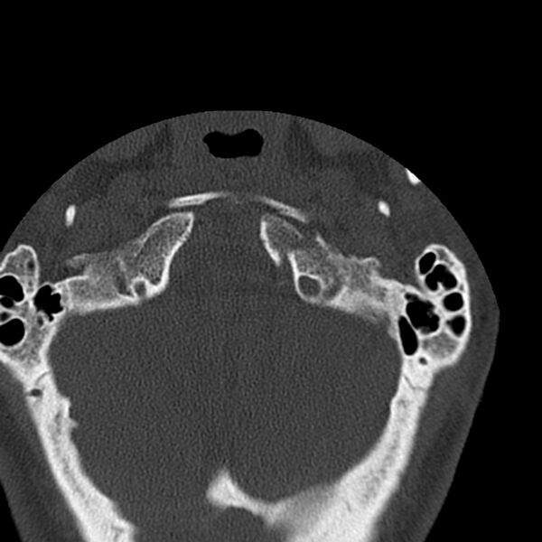 File:Occipital condyle fracture (Radiopaedia 31755-32691 Axial bone window 7).jpg
