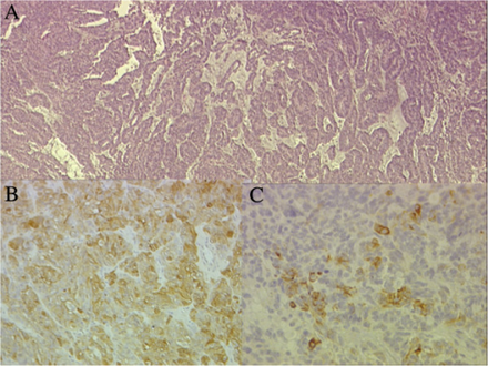 a)Papillary and tubular patterns represent the distinctive appearance of medulloepithelioma b)positivity of the neoplastic cells for S100 protein c) PanCytokeratin