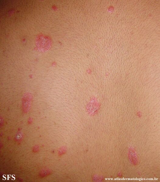 File:Psoriasis (Dermatology Atlas 150).jpg