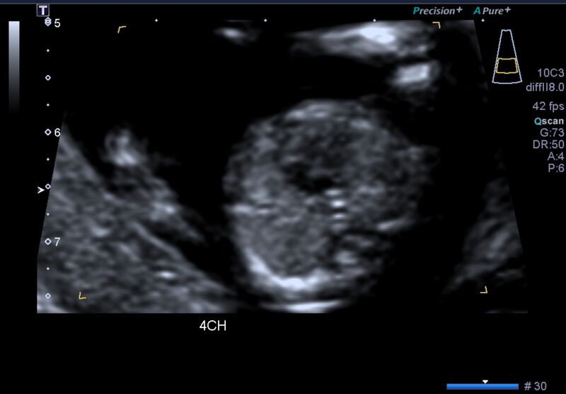 File:1st trimester nuchal-morphology ultrasound (Radiopaedia 44706-48477 General anatomy and NT 20).jpg