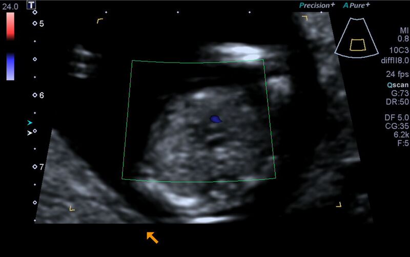 File:1st trimester nuchal-morphology ultrasound (Radiopaedia 44706-48477 Heart views cine with colour 120).jpg