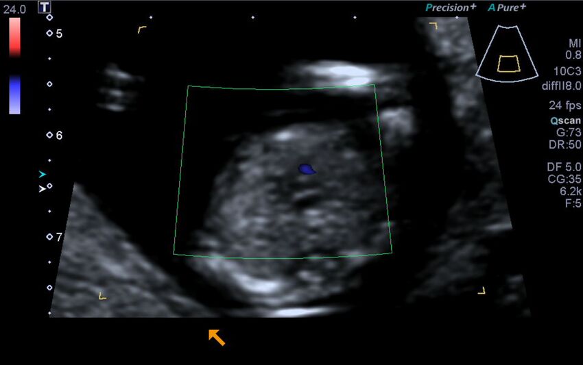 1st trimester nuchal-morphology ultrasound (Radiopaedia 44706-48477 Heart views cine with colour 120).jpg