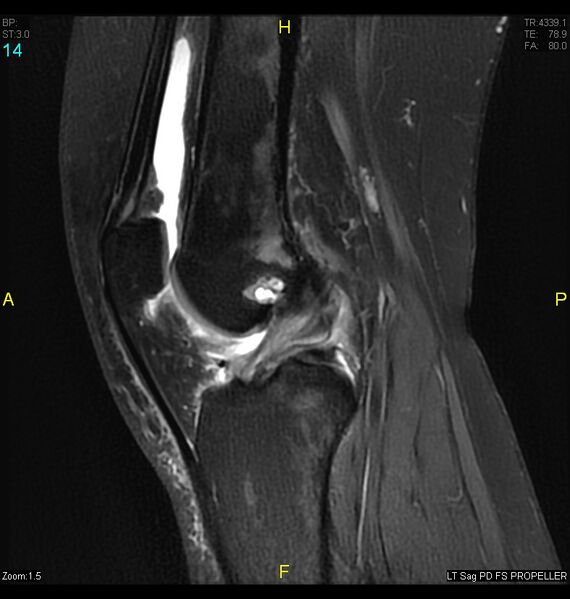 File:ACL mucoid degeration with cystic changes (Radiopaedia 48428-53341 Sagittal PD fat sat 12).jpg