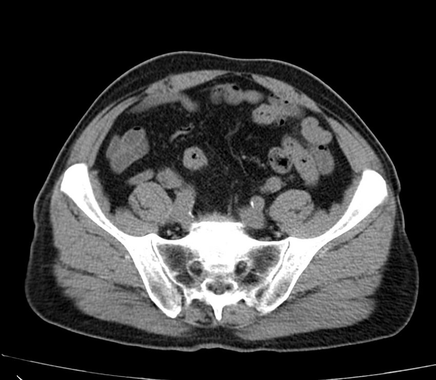 Abdominal aortic aneurysm (Radiopaedia 22421-22458 non-contrast 42).jpg