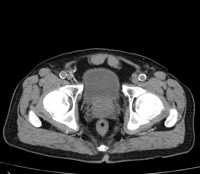 File:Abdominal aortic aneurysm (Radiopaedia 22421-22458 non-contrast 54).jpg