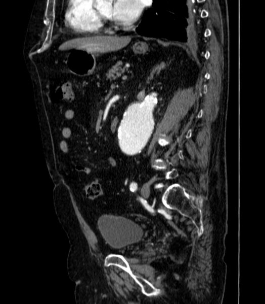 File:Abdominal aortic aneurysm (Radiopaedia 25855-26001 Sagittal C+ arterial phase 38).jpg