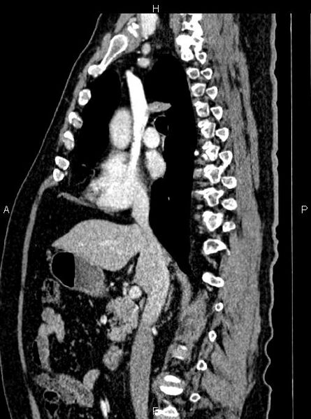 File:Abdominal aortic aneurysm (Radiopaedia 83094-97462 Sagittal renal cortical phase 56).jpg